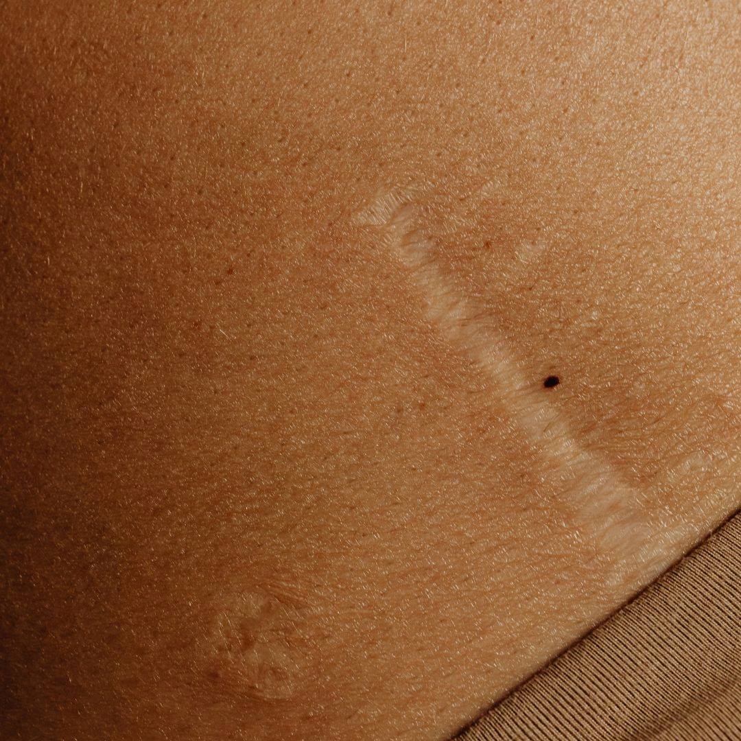 Arpikäsittely Arpikäsittely